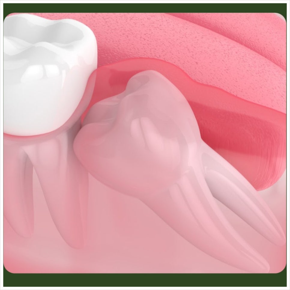 After Wisdom Tooth Extraction: What Should You Watch for With Bleeding Control? image 5