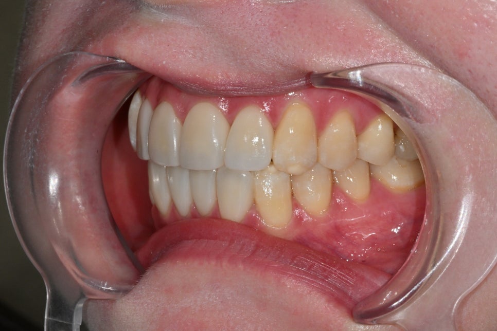 Songpa Dental Clinic: A Case of Improving Mottled Teeth with Veneers image 9