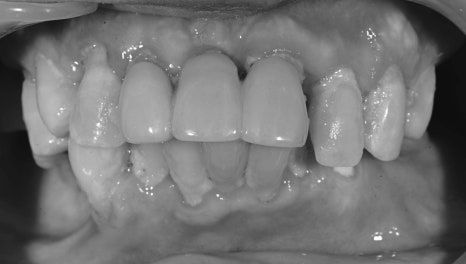 How Are Snap-On Dentures and Full-Mouth Implant Costs Handled at an Implant Dental Clinic? image 5