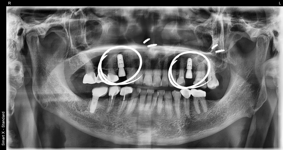 A Surgical Case of a Male Patient in His 70s Restoring Healthy Eating Habits with Insurance-Covered Implants image 2