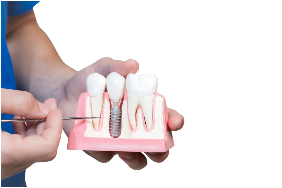 What Is Second-Stage Implant Surgery? Find Out Here! image 2