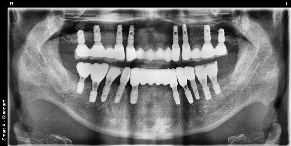 Immediate Implant Placement After Extraction! Seoulove Dental’s Fast Full-Mouth Implant Treatment Completed in 4 Months image 6