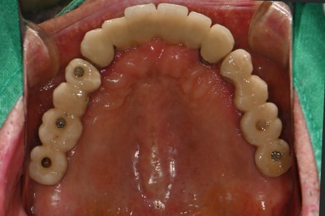Immediate Implant Placement After Extraction! Seoulove Dental’s Fast Full-Mouth Implant Treatment Completed in 4 Months image 3