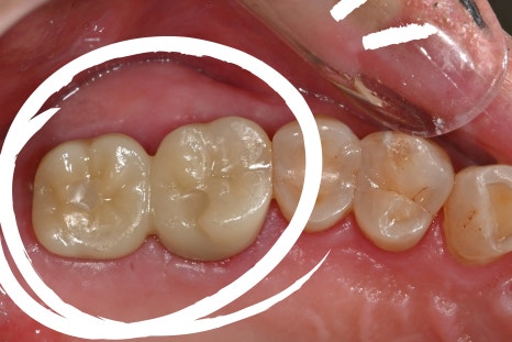 Things You Must Check Before Implant Treatment image 26