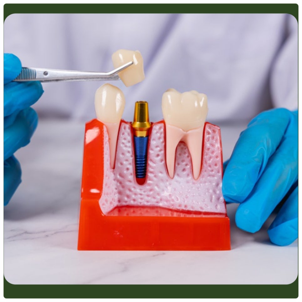 Peri-Implantitis: Proper Care Is Needed to Prevent It! image 5