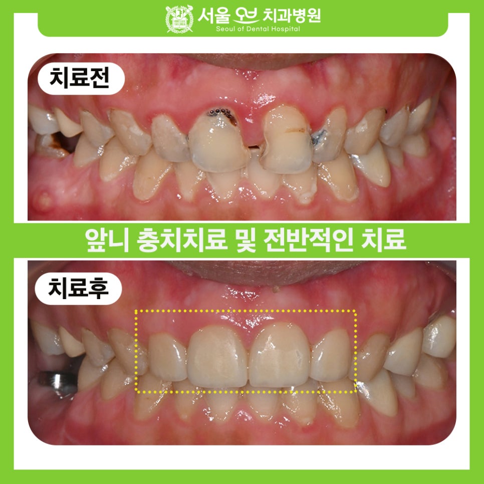 [Seokchon Station Dental Clinic] Overcoming Dental Phobia with Evening and Sunday Treatment! image 1