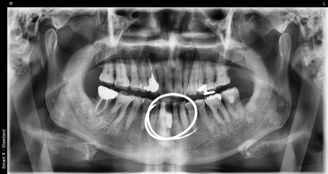 Implant Surgery and Precautions for Insurance Patients in Their 60s image 2