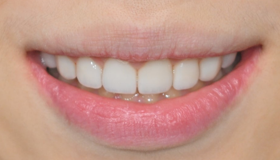 Samjeon Station Dental Clinic: A Case of Improving Discolored Teeth with No-Prep Ove Zero Laminates image 10