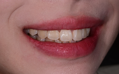 Objeo Laminate Cost, Treatment Review from a Woman in Her 20s image 7