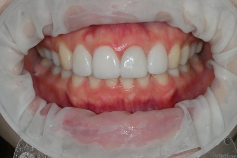 Rabbit Teeth Veneers: Treatment to Achieve Natural Front-Tooth Proportions image 5