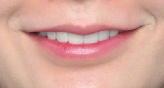 Tooth Wear: Resin? Veneers Are Also an Option image 11