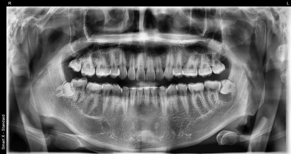Cysts, If Left Untreated, Can Even Dissolve Bone. Introduction to an Accurate Diagnosis and Surgical Case image 2