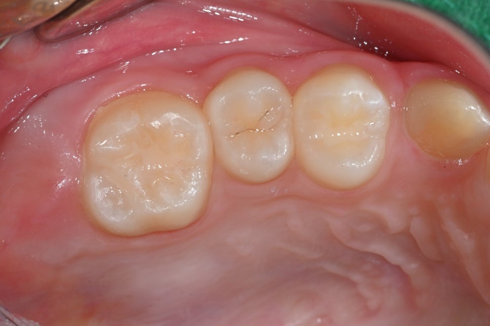 How to Restore Molars with Insurance-Covered Resin for Elementary School Cavities - Seoul of Dental Hospital image 3