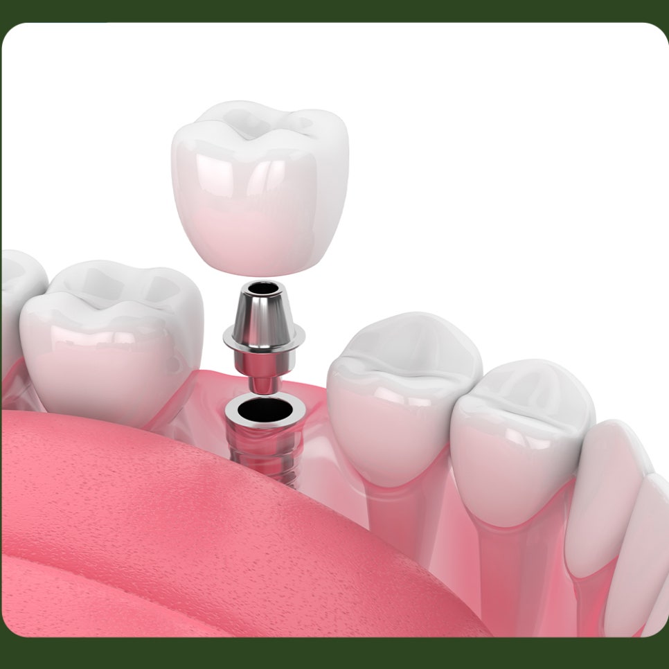 Implants for Those Aged 65 and Over: Are You Eligible? image 2