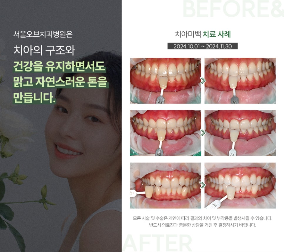 Jamsil Teeth Whitening: Can You See Results in Just One Day? image 1