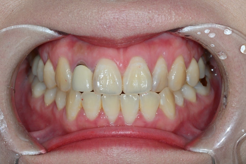 How We Naturally Improved an Upper Front Tooth Crown Retreatment, Including Color Differences and the Gum Line image 13