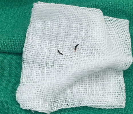 Samjeon Station Implant: Why do some break while others can last a lifetime? image 6