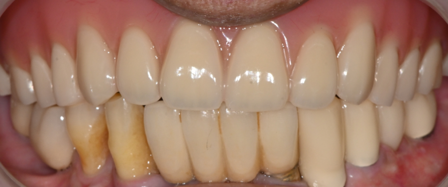 A Case Where Eating Discomfort Was Resolved with a Full Denture image 19