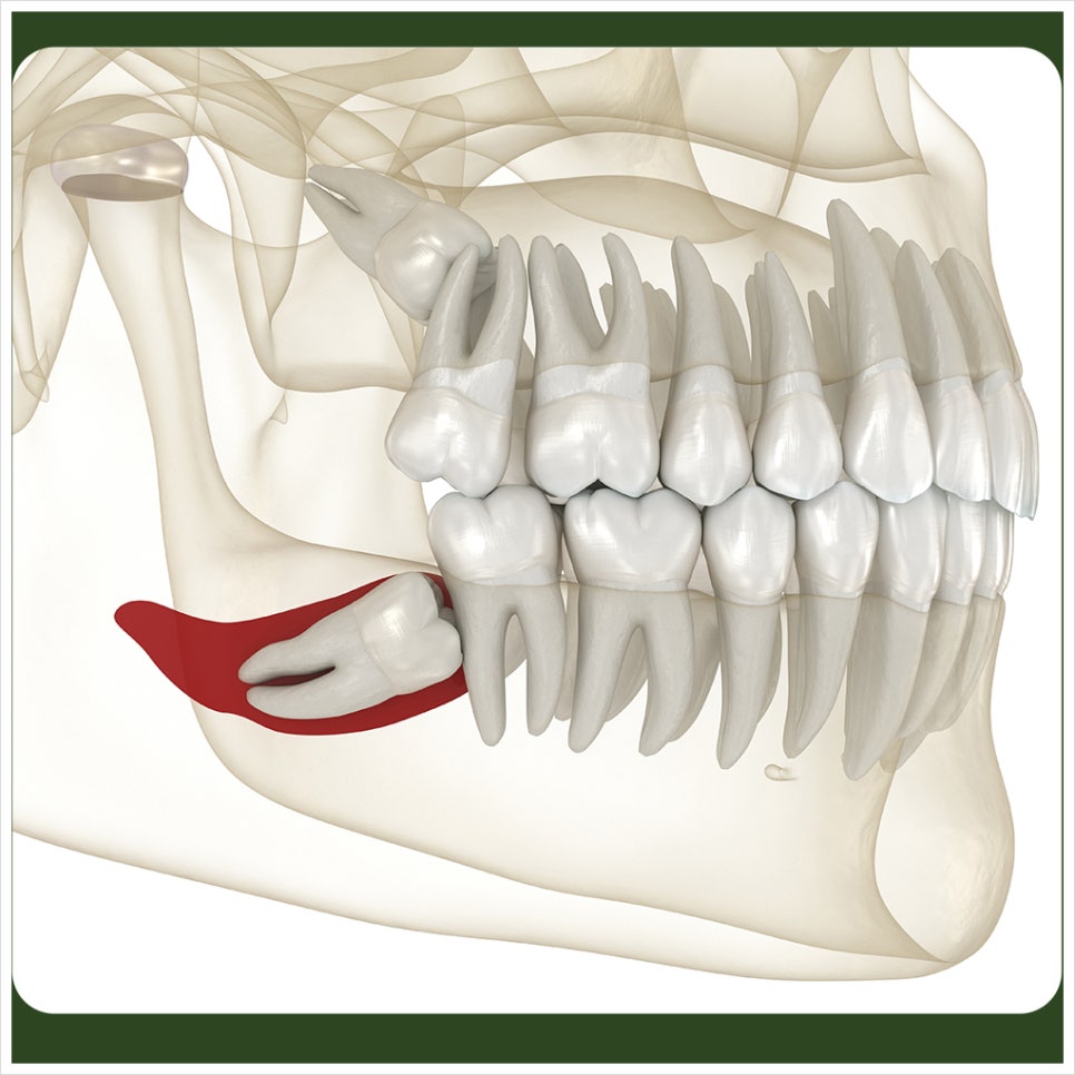 Why Should You Be Careful About Smoking After Wisdom Tooth Extraction? image 2