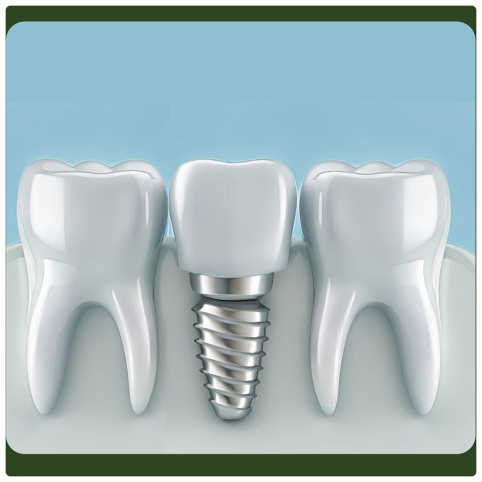 Peri-Implantitis: Proper Care Is Needed to Prevent It! image 3