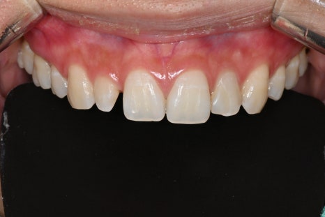 What If a Resin Filling Fell Out in the Past? Be Sure to Read This Before Retreatment! image 2