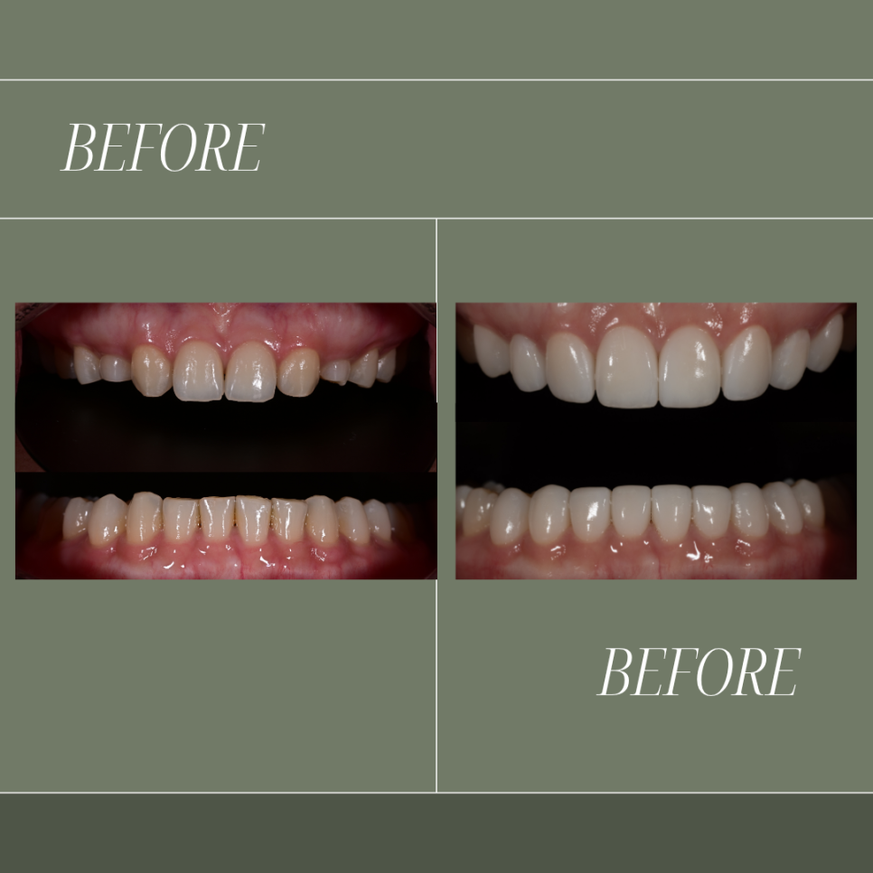 Minimally Invasive Laminate Veneers, Simultaneous Tooth Shaping with Obezero Laminate image 15