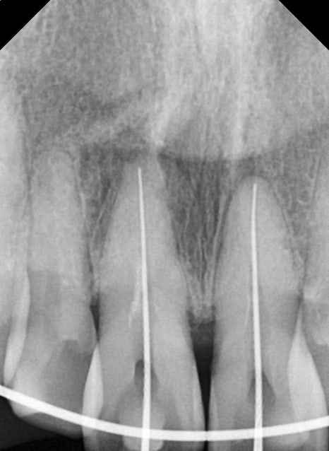 Treatment Process Revealed for a Fall That Injured Both the Front Teeth and Lip image 16