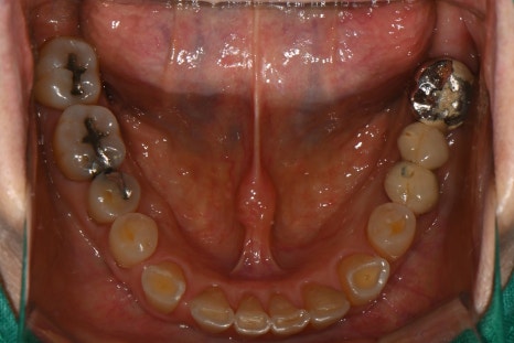 Front Tooth Crown + Implant for an Overseas Patient: What Made It Possible to Finish in 4 Months? image 3