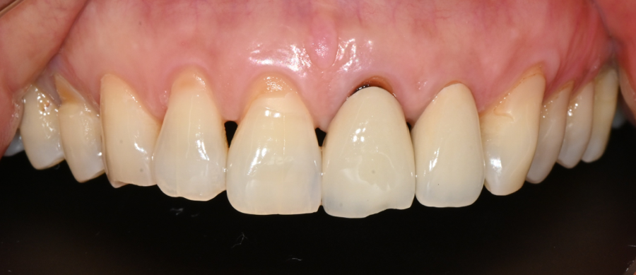 How Was Sensitivity and Discomfort Resolved After Implant Treatment in Jamsil? image 15
