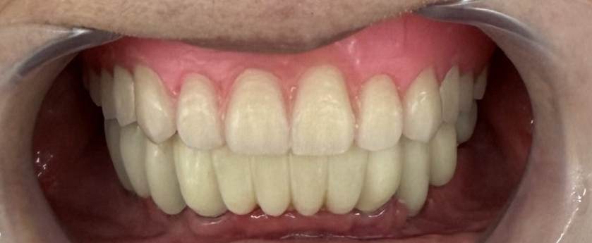 How Are Snap-On Dentures and Full-Mouth Implant Costs Handled at an Implant Dental Clinic? image 10