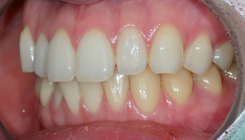 Canine Veneers Without Orthodontic Treatment image 3