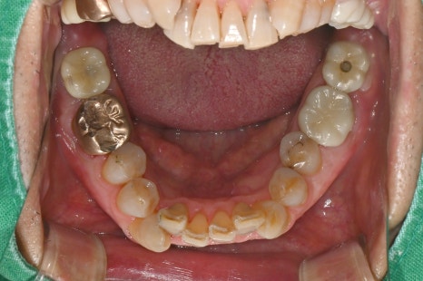 No Problem Even for Implants from Another Clinic! If You Only Need Screw Hole Filling, Seoul Of Dental Hospital Can Help🛠️ image 2