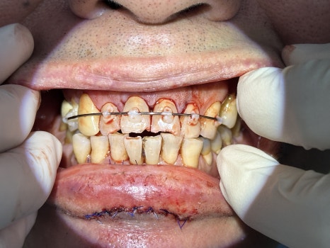 A Broken Front Tooth from a Fall, Restored Along with the Gums! Emergency Treatment Report from Seoul Ob Dental Hospital image 2