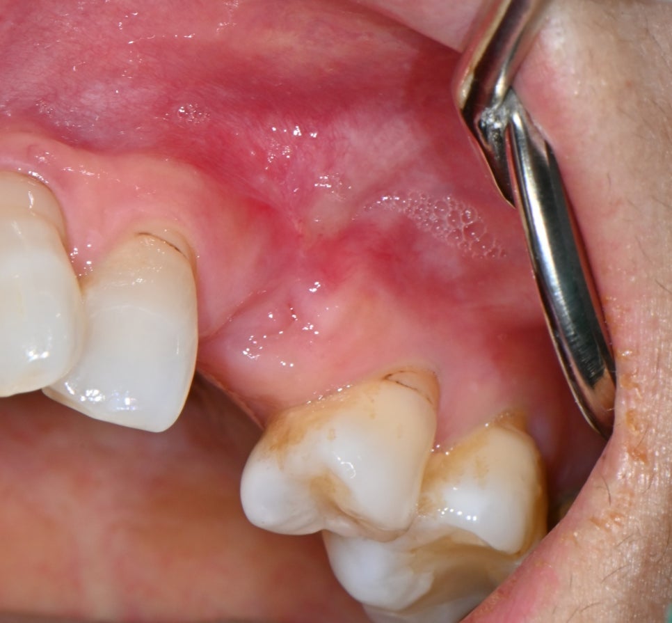 Songpa-gu Front Tooth Implant: Is It Possible Even in an Inflamed Area? image 6