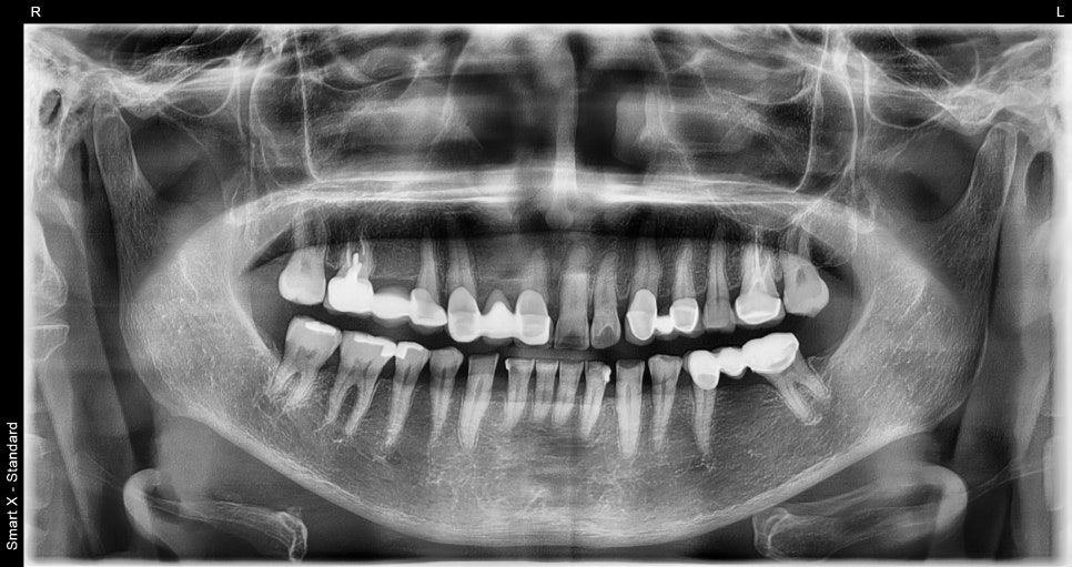 Front Tooth Crown + Implant for an Overseas Patient: What Made It Possible to Finish in 4 Months? image 1