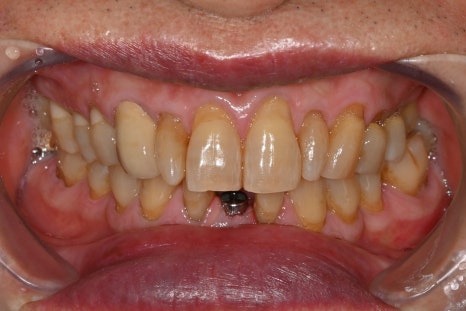 Implant Surgery and Precautions for Insurance Patients in Their 60s image 3