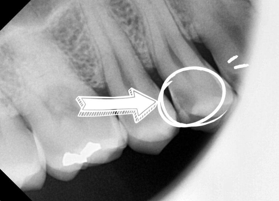 Why Cracked Molar Pain Means You May Need Root Canal Treatment image 7