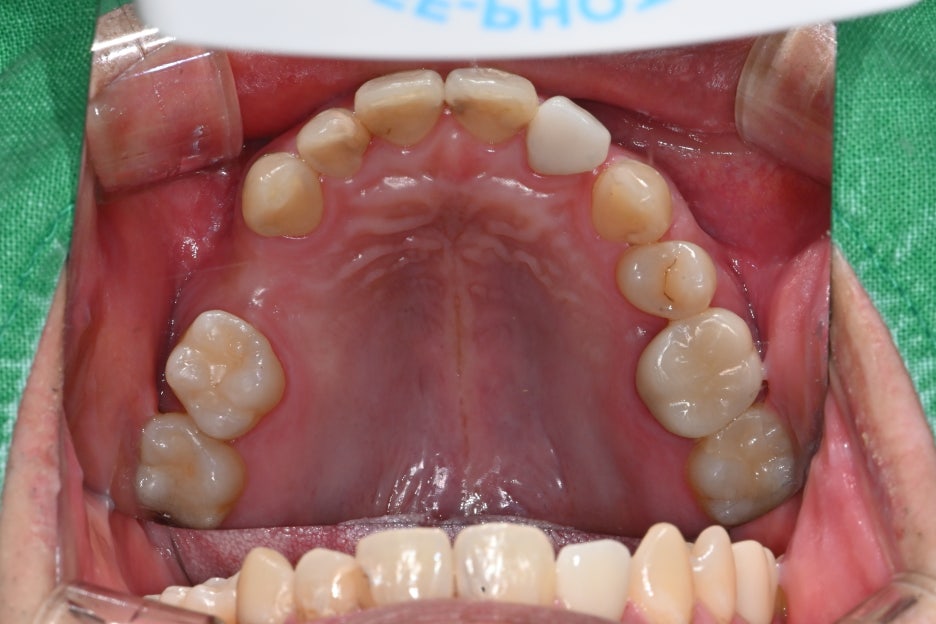 Songpa Dental Clinic: Implant After Molar Extraction image 10
