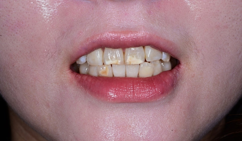 Songpa Dental Clinic: A Case of Improving Mottled Teeth with Veneers image 1