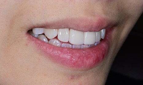 Laminate Veneers for Protruding Teeth: If They’re Too Thick, They Look Even More Prominent image 11