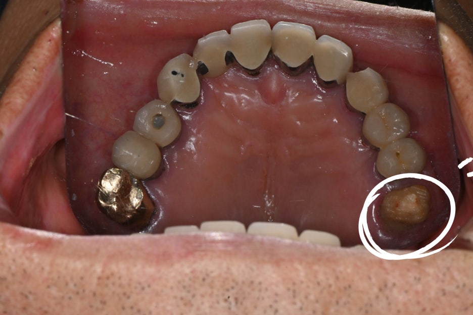 Why the First Root Canal Procedure Must Be Handled by a Specialist image 4