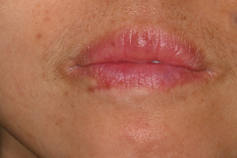 Treatment Process Revealed for a Fall That Injured Both the Front Teeth and Lip image 18