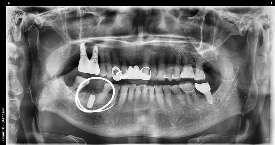 Understanding Implant Price Differences Through the Molar Implant Process image 9