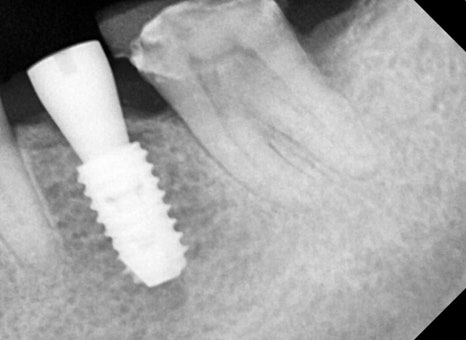 Are you afraid of the dentist? With sedation treatment, you can get root canal treatment and implant surgery without worry! image 2