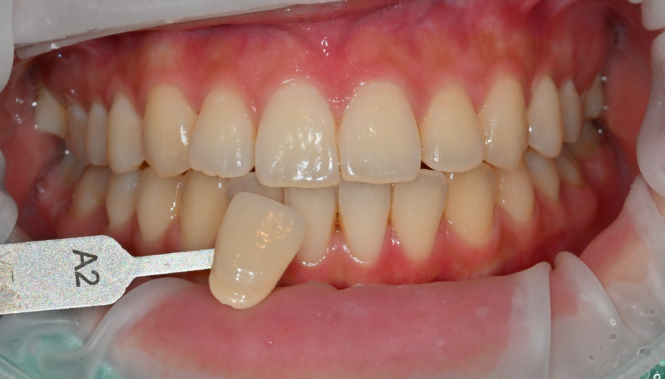 Jamsil Teeth Whitening: Can You See Results in Just One Day? image 5