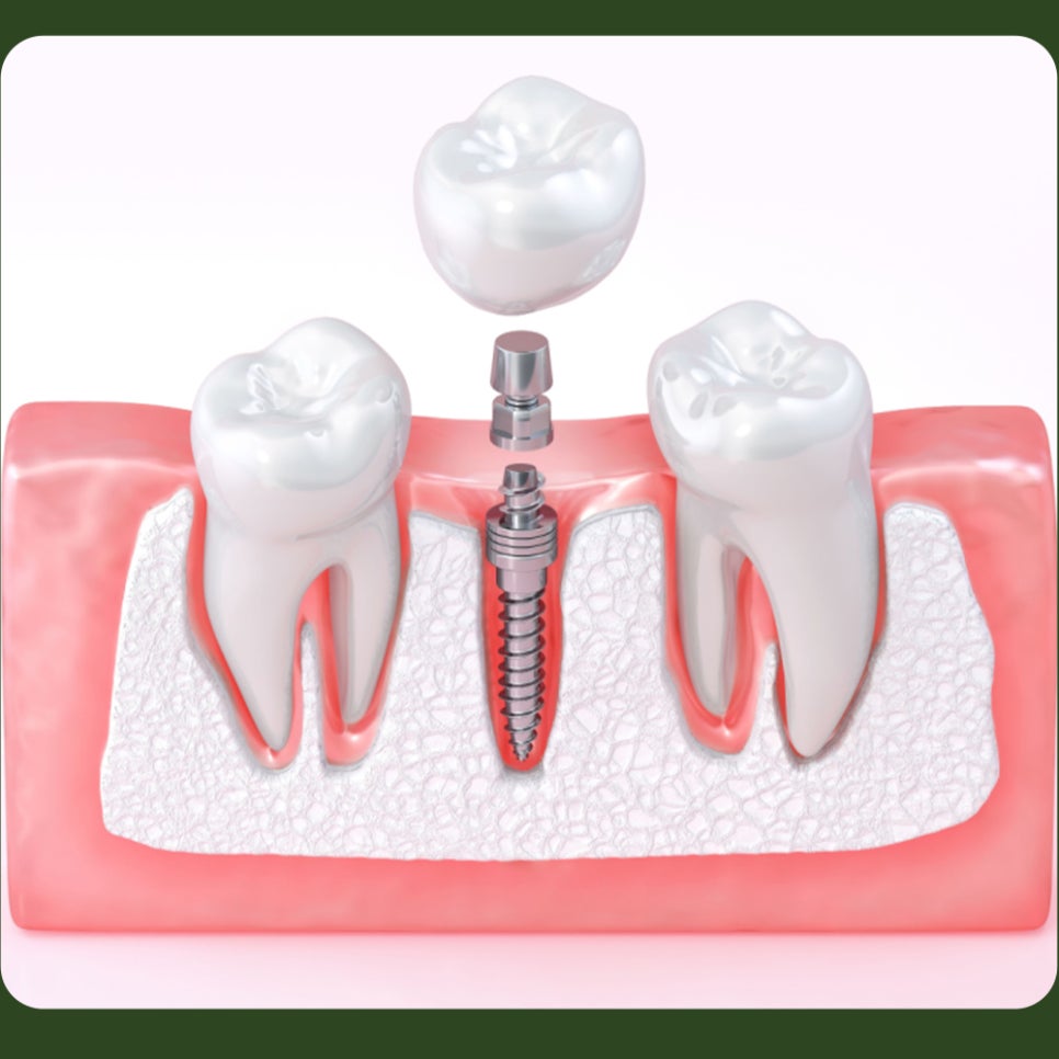 When Is Bone Grafting Needed for Implants? image 4