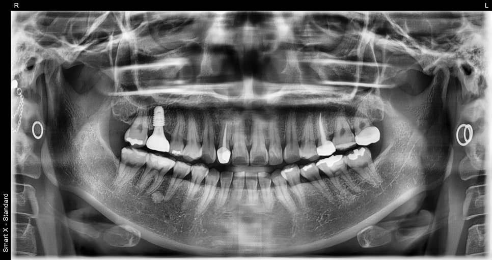 How We Naturally Improved an Upper Front Tooth Crown Retreatment, Including Color Differences and the Gum Line image 2