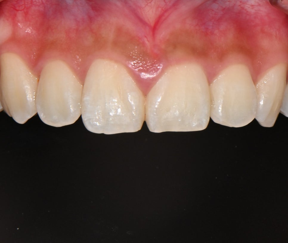 Samjeon Station Dental Clinic: "Without Orthodontics, Object Zero for the Smile Line of a Woman in Her 20s" image 9