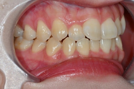 Why the Front Teeth Laminate Changed Naturally with Obzero Laminate image 5