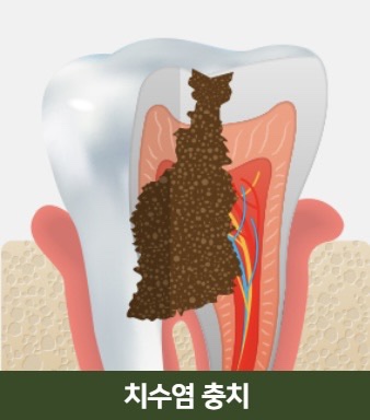 The Power to Protect Natural Teeth: Seoul Orbe Dental Hospital’s Philosophy of Conservative Treatment image 5